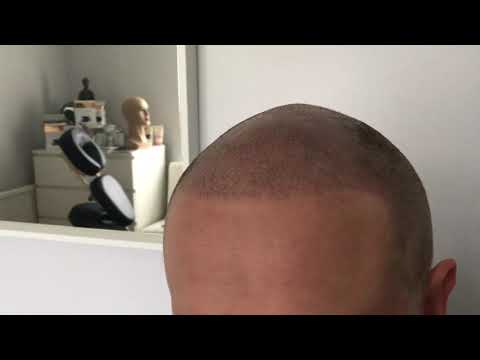 Scalp Micropigmentation - Scalp Tattoo Transformation