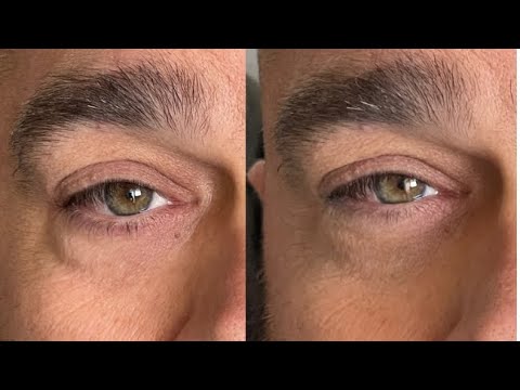 Demonstration of how to apply Demi Method for under eye bags