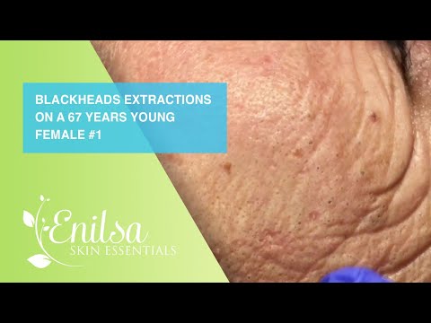 Blackheads Extractions on a 67 Years Young Female