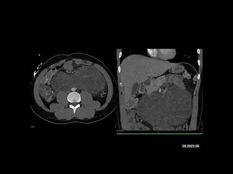 Radiology Case of the Week: The most likely diagnosis in this case is?