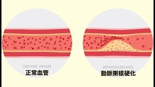 血栓疾病的危害｜蔣威廉｜紐約血液腫瘤專家｜健康1+1直播間