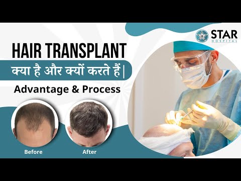 Hair Transplant - Process, Results, Before and After in Hindi | Hair Transplant कैसे करते हैं?