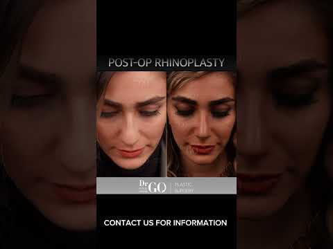 Before and After Rhinoplasty - Dr Guncel Ozturk #beforeandafter #rhinoplastyturkey #drgo