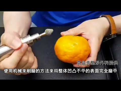 整形常識15-去除青春痘疤時機械削皮術和鐳射激光削皮術的差異