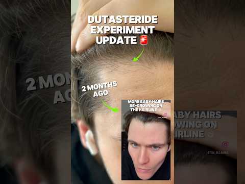 DUTASTERIDE HAIR GROWTH EXPERIMENT UPDATE! 🚨