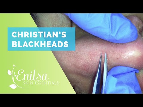 Christian’s Blackhead Extractions Latest Video