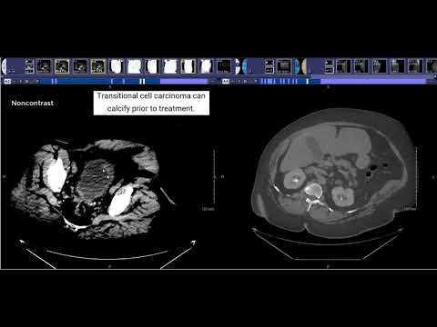 CT Urogram