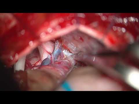 Pontine cavernous malformation: microsurgery evading the floor of the fourth ventricle