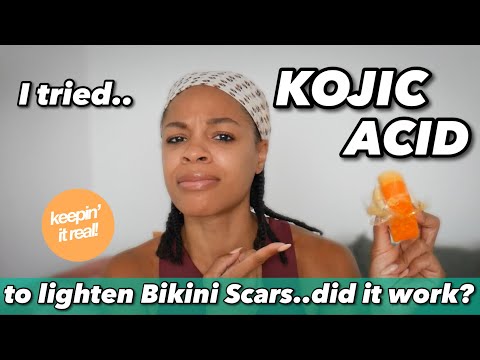 KOJIC ACID Soap to lighten Bikini Dark Marks|Does it REALLY work?  Hyperpigmentation Routine Results