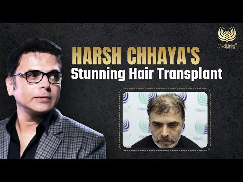 Harsh Chhaya’s Stunning Hair Transplant!! | Celebrity Hair Goals! | MedLink