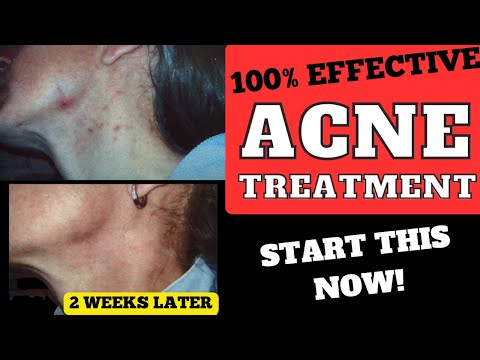 START THESE DIETARY CHANGES NOW Clear ACNE / Psoriasis / Eczema