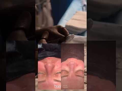 Behind the Scenes: A Day in Rhinoplasty Surgery with Assoc. Prof. Dr. Güncel Öztürk