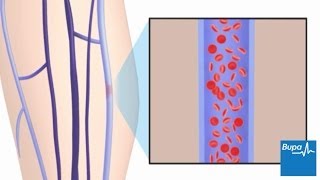 How superficial thrombophlebitis develops