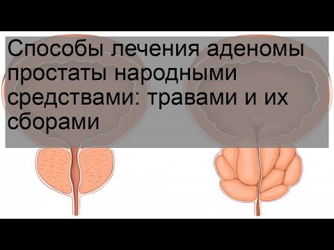 Способы лечения аденомы простаты народными средствами: травами и их сборами