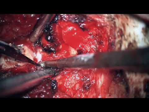 C1 hypertrophic lateral mass resection and occiput–C2 fusion