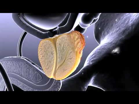 Prostate Health - Considerations in Advanced Prostate Cancer