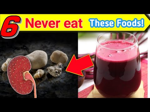 Never eat these foods! | 06 Bad foods for kidney stones | Kidney stones avoid foods/STAR LABORATORY