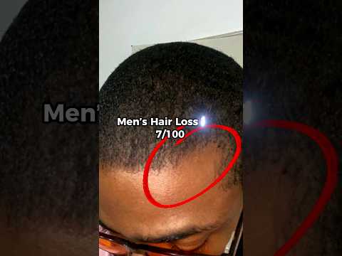 A vitamin a day to get your hair to stay?? | Vitamin D for Thinning Hairline (Tips 7/100)