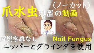 【ノーカット】爪水虫（白癬）処置の動画：巻き爪・陥入爪治療の相談室　Treatment of tinea unguium ( Nail fungus)