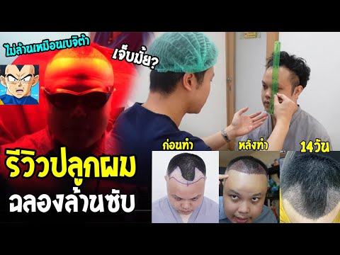 รีวิวปลูกผม ฉลอง 1,000,000 ซับ ใครหัวล้านหมดปัญหาต้องดู !? ปลูกที่ COSMO CLINIC คุ้มค่า - OverReview