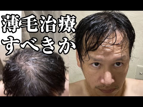 薄毛治療すべきか悩んでます【40代のAGA治療】