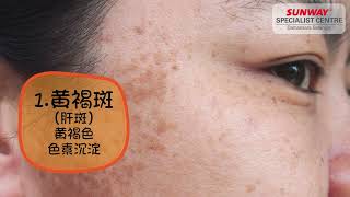 Skin Pigmentation & Laser Treatment by Dr Teh Yeon Chiat