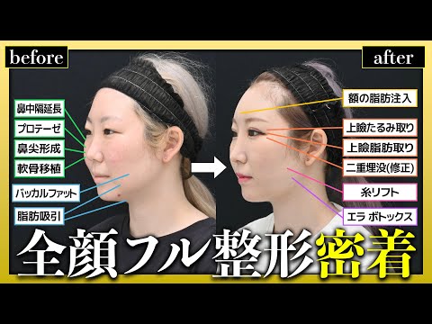 【25歳 全顔フル整形】目・鼻・輪郭を同時に施術！“自然”で”自分に似合う"整形を目指すゆうこさんのフル整形に密着【フルオーダー】