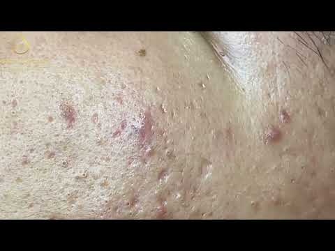 Loan Nguyen Acne Treatment 129e