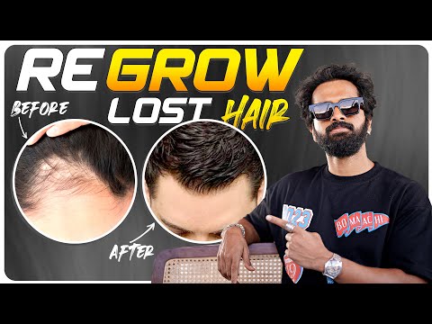 Click Here👆-5 Steps To *REGROW* Receding Hairline (Naturally)