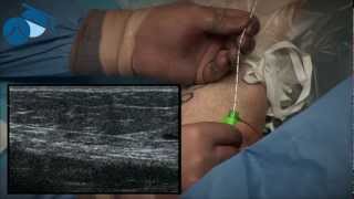 Treatment of Great Saphenous Vein with radial EndoVenous Laser Ablation (EVLA)