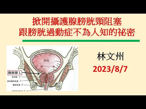 掀開攝護腺膀胱頸阻塞跟膀胱過動症不為人知的祕密－林文州202308022增訂版