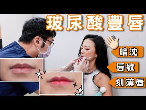 刻薄唇➡️歐美唇👄｜玻尿酸豐唇初體驗｜我也有微笑唇啦😆｜緹神醒腦 ft. @skindrtw_beauty