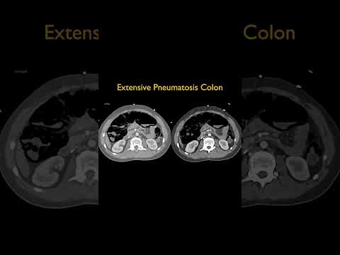 Extensive Pneumatosis Colon