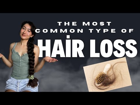 The most common type of HAIR LOSS. Ep 1