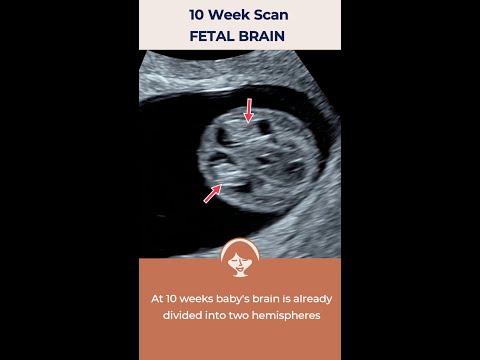 Brain of the 10 weeks fetus.