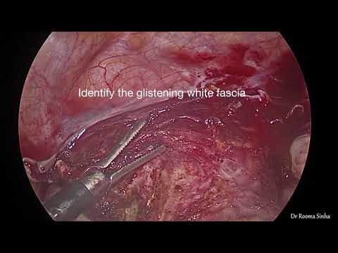 Total Laparoscopic Hysterectomy  simplified Dy Dr Rooma Sinha