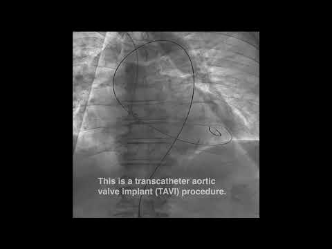 Minimally Invasive TAVI Device | Sunnybrook Health Sciences Centre