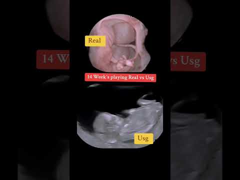 14 Week's playing Inside Womb #babyultrasound #ultrasound #pregnancyscan #baby