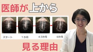 もう迷わない👉自分の育毛剤や薄毛対策が【効果でそうか】早めにわかる方法