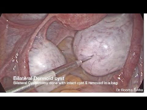 Laparoscopic Ovarian Cystectomy for bilateral Dermoid Rooma Sinha Apollo Hyderabad