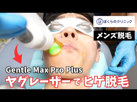 【メンズ脱毛】最強ヤグレーザーGentle Max Pro Plusで髭脱毛した結果がヤバかった・・・【都度払い】