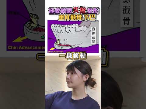 拯救韓國失敗整形❌ 顴骨、下巴重修紀錄 台北教主醫美整形 Dr.郭菁松醫師#韓國削骨失敗 #二次削骨 #顴骨削骨 #下顎骨角削骨 #下巴整型 #客製化削骨 #教主醫美整形 #郭菁松醫師