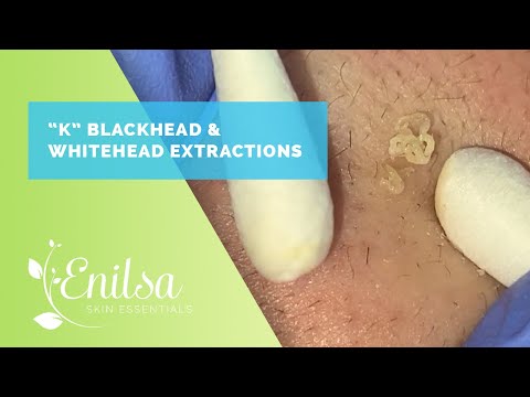 Blackhead & Whitehead Extractions on "K" Part 3