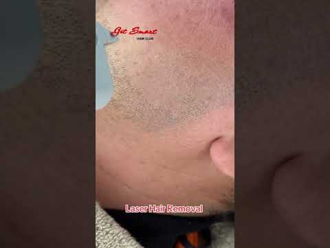 Laser Hair Removal #getsmarthairclub #viralvideo #beauty