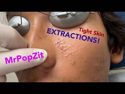 Tight skin acne extractions! Comedonal acne with some inflammatory nodules. Great session must see!