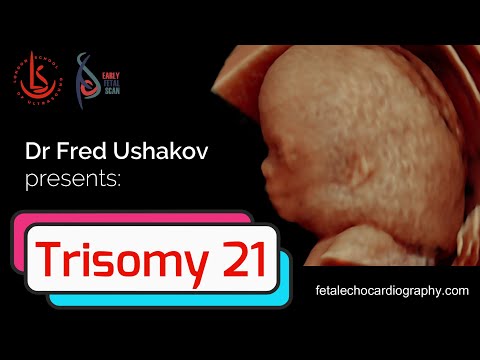 Trisomy 21: Challenges in screening, diagnosis and management of Down's syndrome