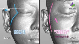 謝明吉院長解說顴骨削骨是否會下垂?