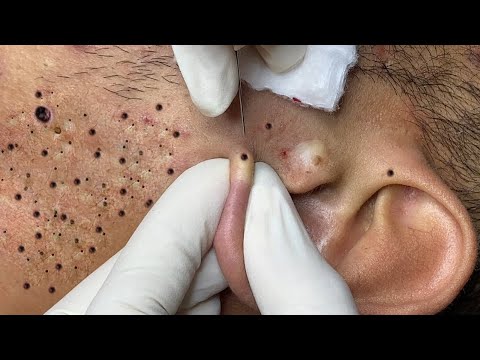 !how to remove blackheads? This video is for you