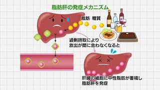 【脂肪肝】正しく理解しよう「脂肪肝」①脂肪肝の原因と症状