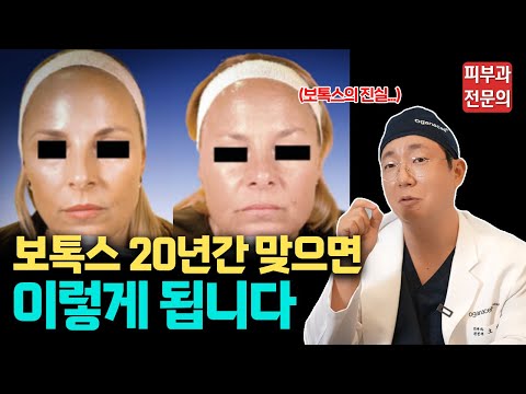 보톡스 20년간 맞았더니...헉!! / 가성비 좋은 보톡스 시술의 진실